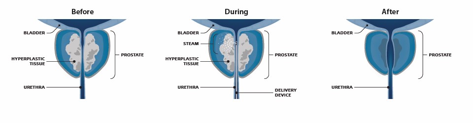Rezūm therapy procedure at Samaritan Hospital for BPH treatment